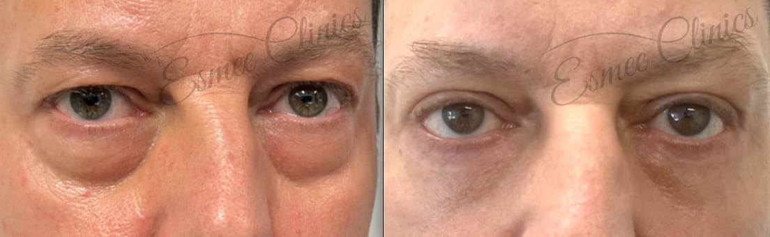 Before and After img